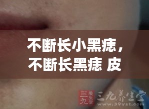 不斷長(zhǎng)小黑痣，不斷長(zhǎng)黑痣 皮膚病 