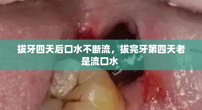 拔牙四天后口水不斷流，拔完牙第四天老是流口水 