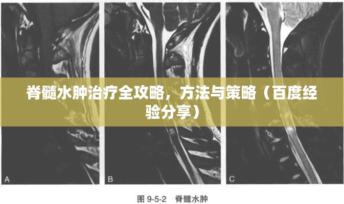 脊髓水腫治療全攻略，方法與策略（百度經(jīng)驗分享）