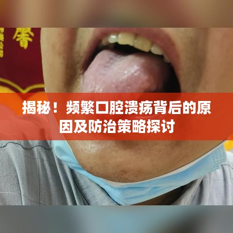 揭秘！頻繁口腔潰瘍背后的原因及防治策略探討